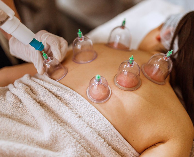 Dry cupping